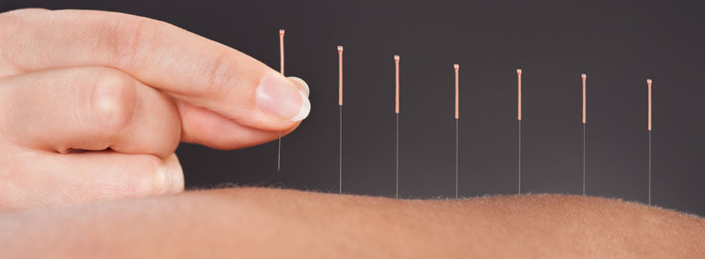 Acupuncture Therapy