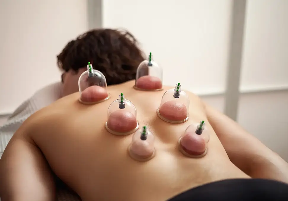 Cupping Therapy